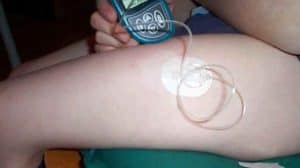 thigh infusion set placement Diabetes Advocacy
