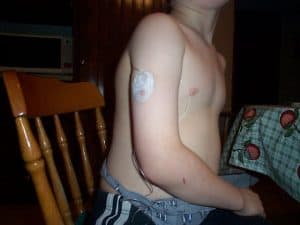arm placement of infusion set Diabetes Advocacy