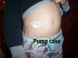 stomach placement of infusion set Diabetes Advocacy 